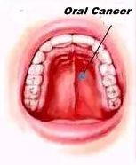Smokeless tobacco, betel nut drive oral cancer cases in India, highest in South Asia: Lancet