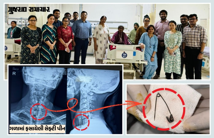 અમદાવાદ: દાંત સાફ કરતી વખતે ખેંચ આવતા મહિલા સેફ્ટી પીન ગળી ગયા, 20 દિવસ બાદ મળ્યો છુટકારો