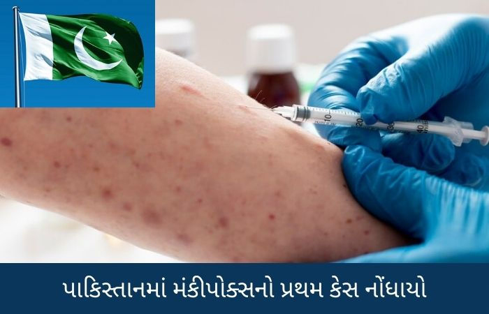 Monkey Pox virus: પાકિસ્તાનમાં મંકીપોક્સનો પ્રથમ કેસ નોંધાયો, કોરોના જેવી વધુ એક મહામારીની આશંકા