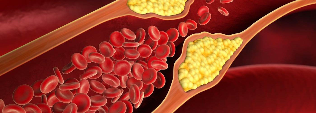 Covid infection spiked high cholesterol risk by 30%: Study