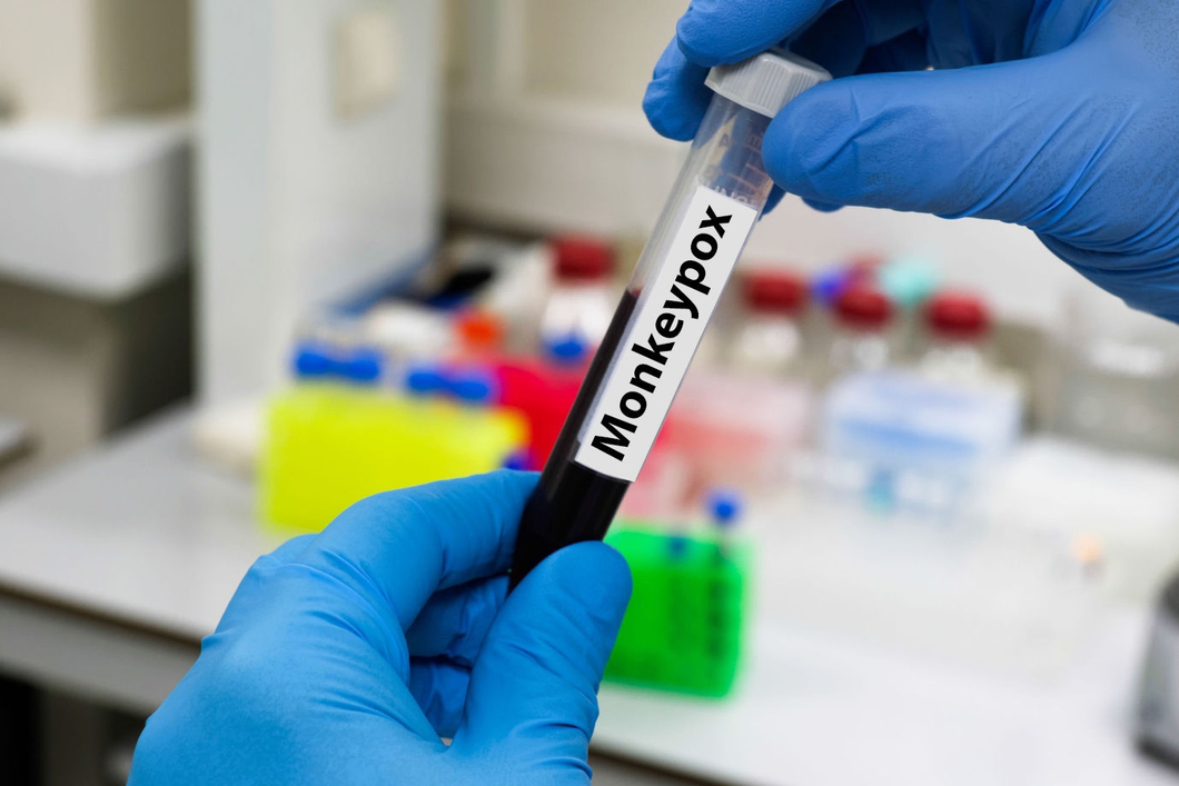 Zambia confirms second mpox death as cases rise to 49