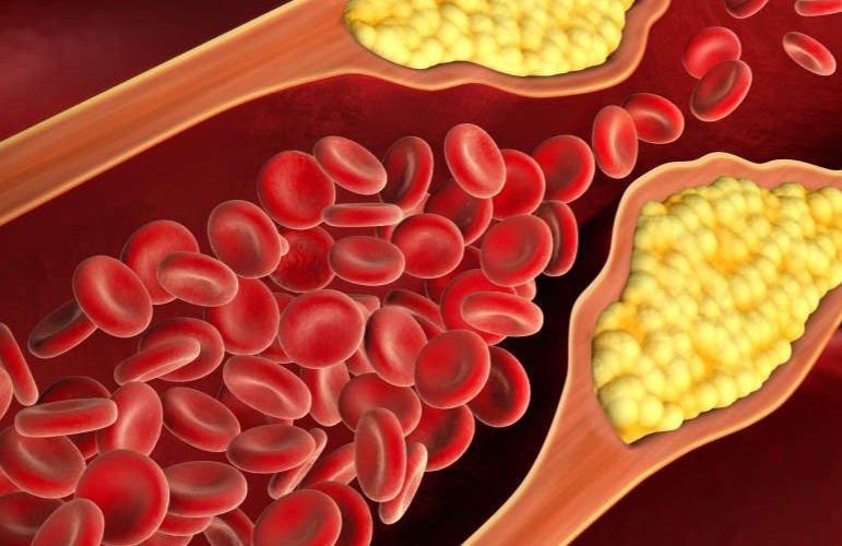 Indian scientists develop optical sensing platform to detect cholesterol