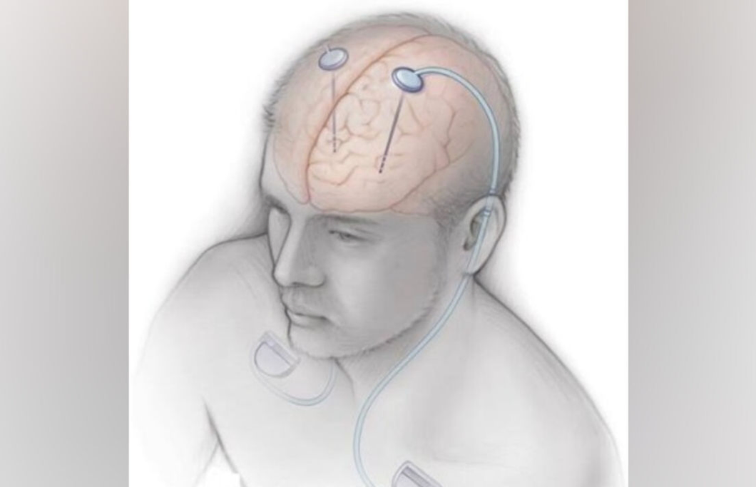 Brain stimulation shows promise for patients with severe OCD, study finds