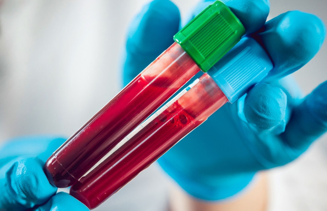 US FDA clears first-ever blood test to help diagnose Alzheimer’s ...