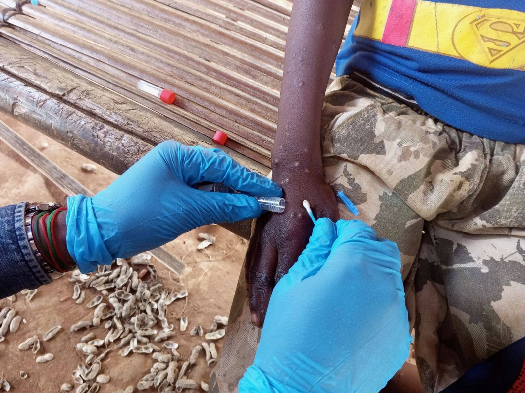 WHO declares global health emergency over Mpox outbreak