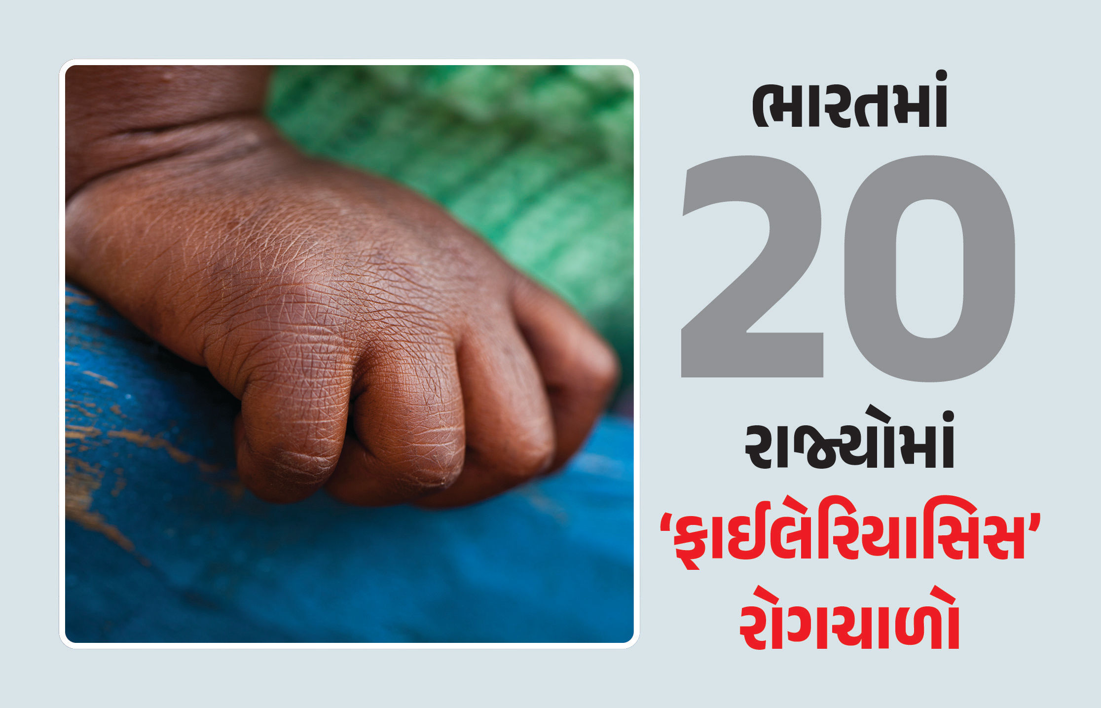 ભારતમાં 250 જિલ્લામાં ‘ફાઈલેરિયાસિસ’નો રોગચાળો... જાણો કેટલી ખતરનાક છે આ બિમારી?