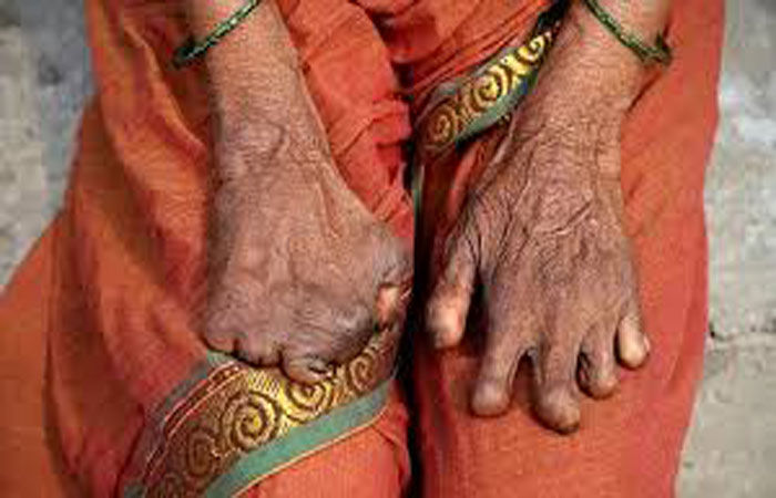 રક્તપિત્ત વિશેનો અહેવાલ બે સપ્તાહમાં  ફરજિયાત રજૂ કરવો પડશે