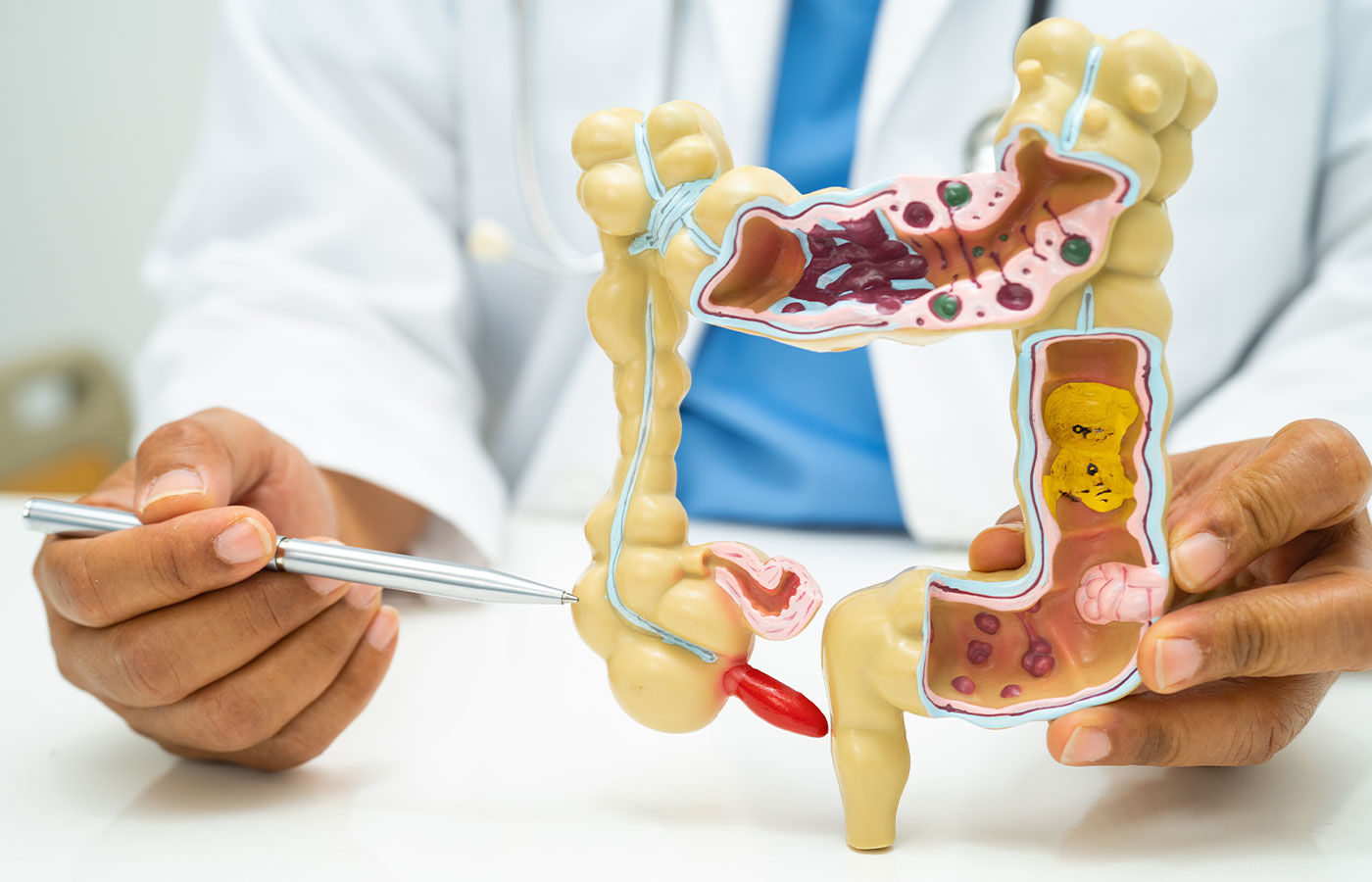 Late diagnosis of appendix cancer a concern, say experts