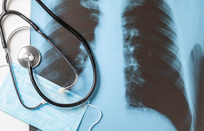 Gujarat sees 2.78 lakh TB cases, 10,000 deaths in two years amid push for eradication