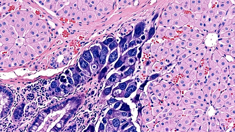 Loss of GATA6 Gene Key to Colon Cancer's Deadly Spread to the Liver, Study Finds