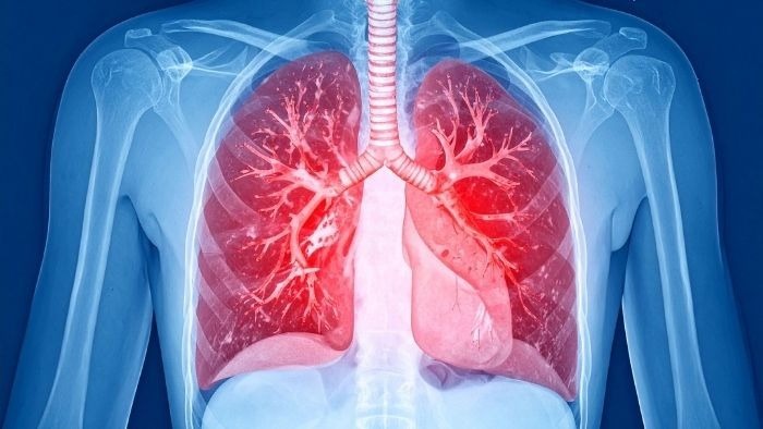 TB Treatment Under Threat As Standard Tests Miss Some Resistance Mutations