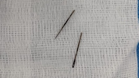AIIMS Rajkot Doctors Remove Metal Pin From 12-Year-Old Girl’s Intestine Without Surgery